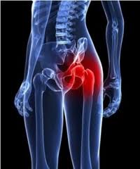 Wright Profemur Hip Replacement: Adverse events